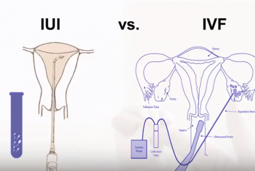 What To Know When Comparing IVF And IUI