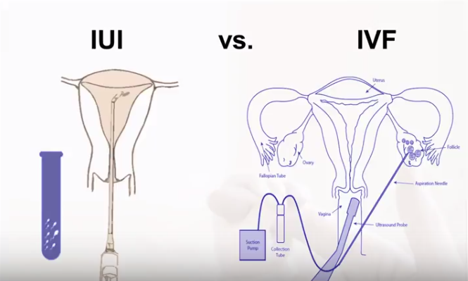 What To Know When Comparing IVF And IUI